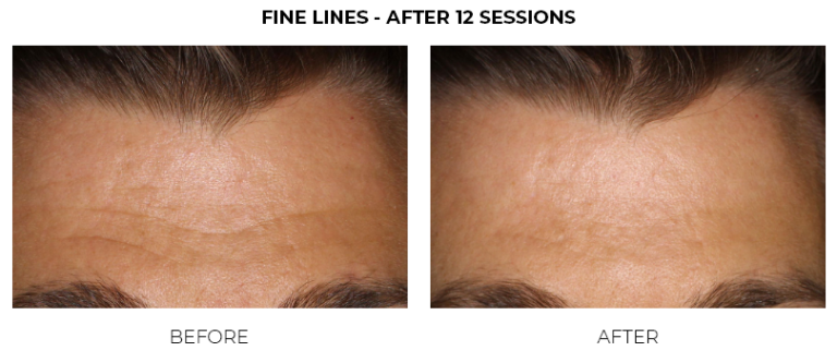 FINE LINES