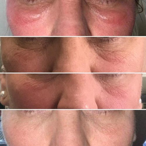 @purehairbeautydalby - 2 treatments in 2 days