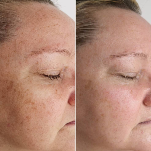 Flex MD Pigmentation