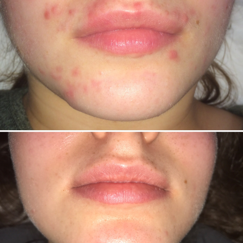 Spot Prone Skin 2