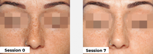 Depigmentation