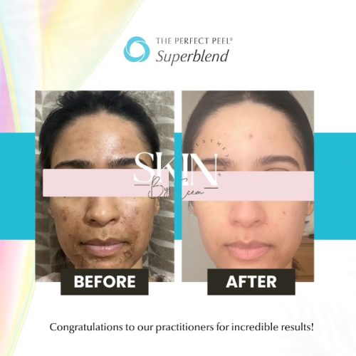 peel-results-1