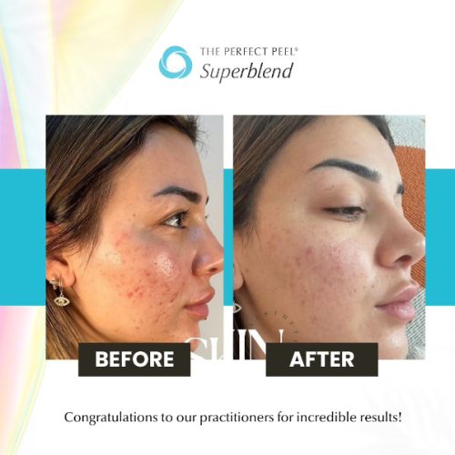 peel-results-2