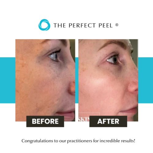 peel-results-3